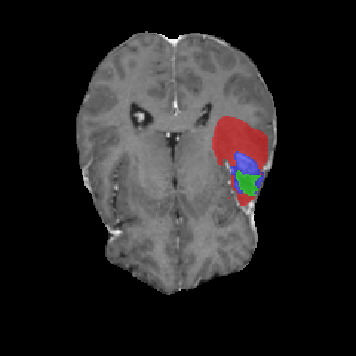 Case 1 Normalization