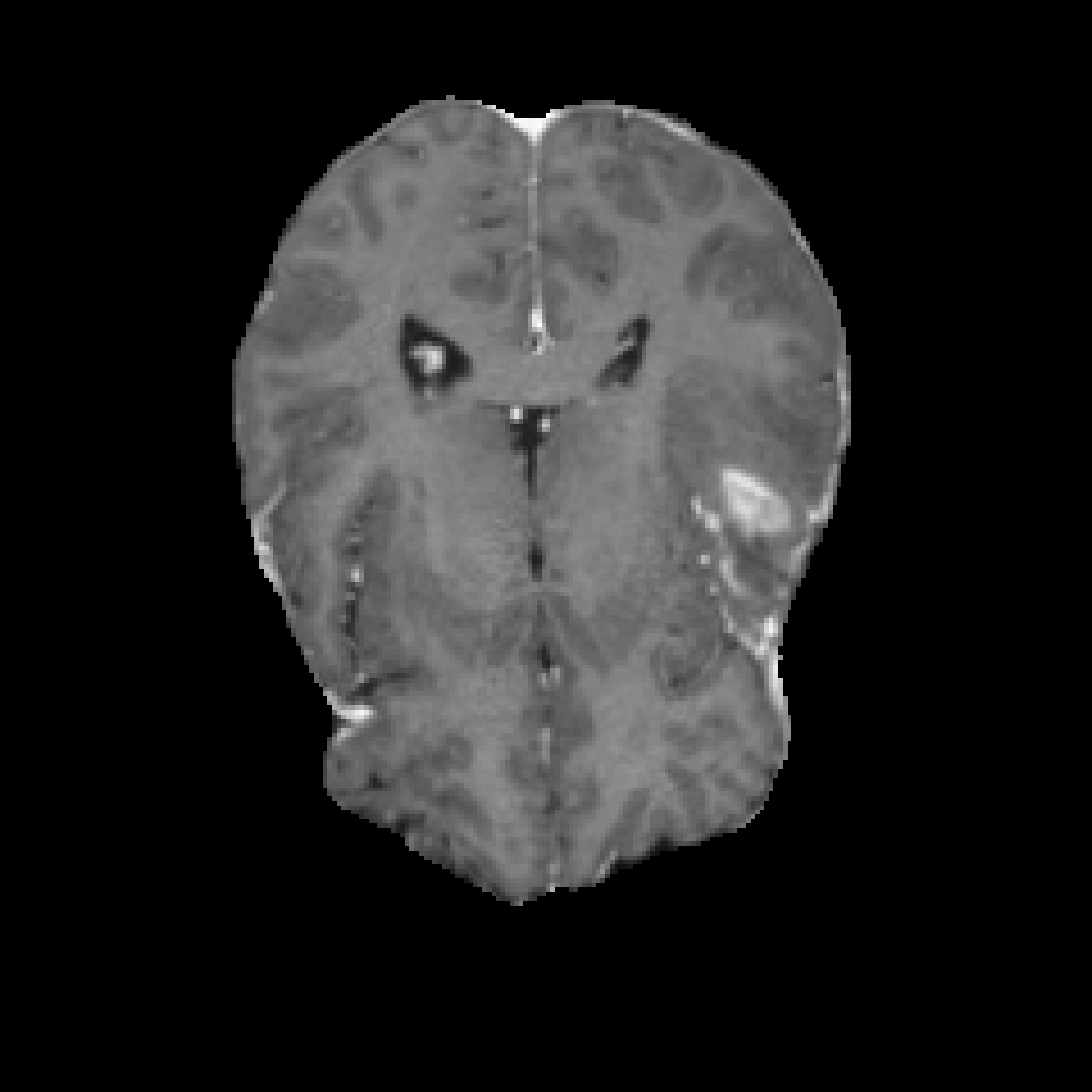 Case 1 T1c