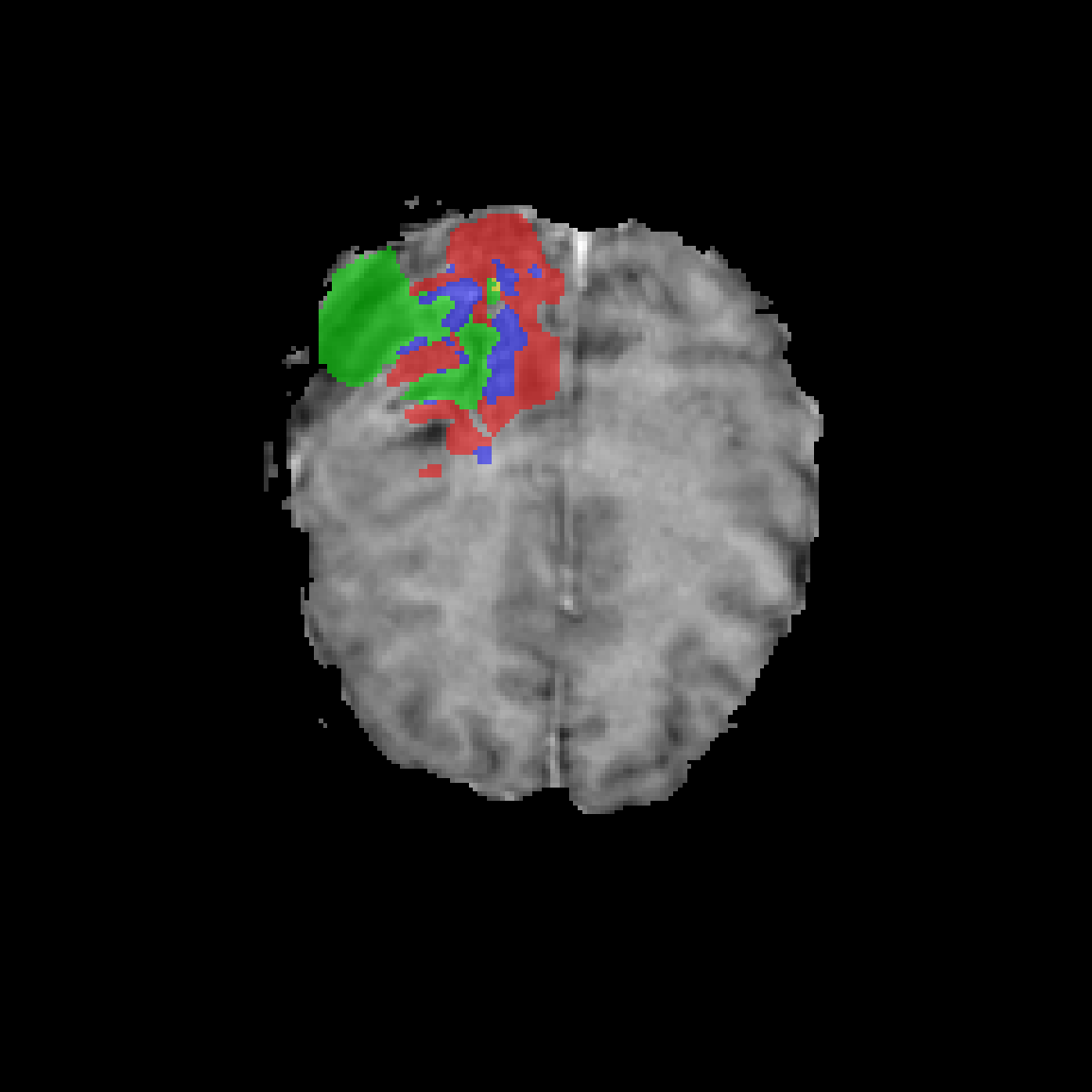 Case 2 Normalization