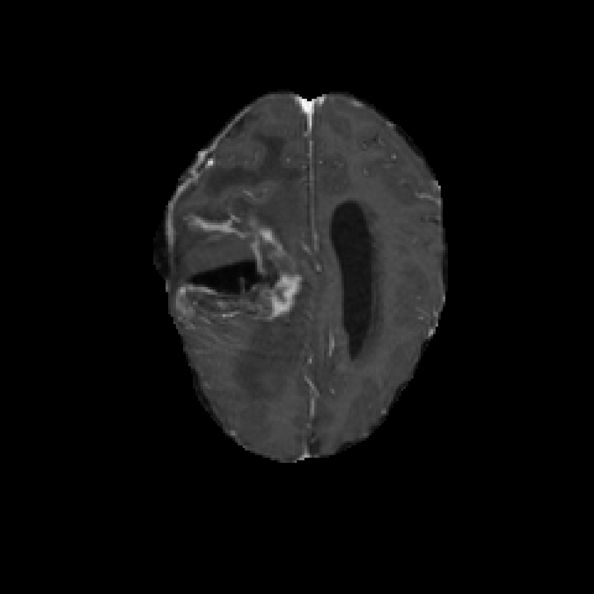 Case 3 T1c